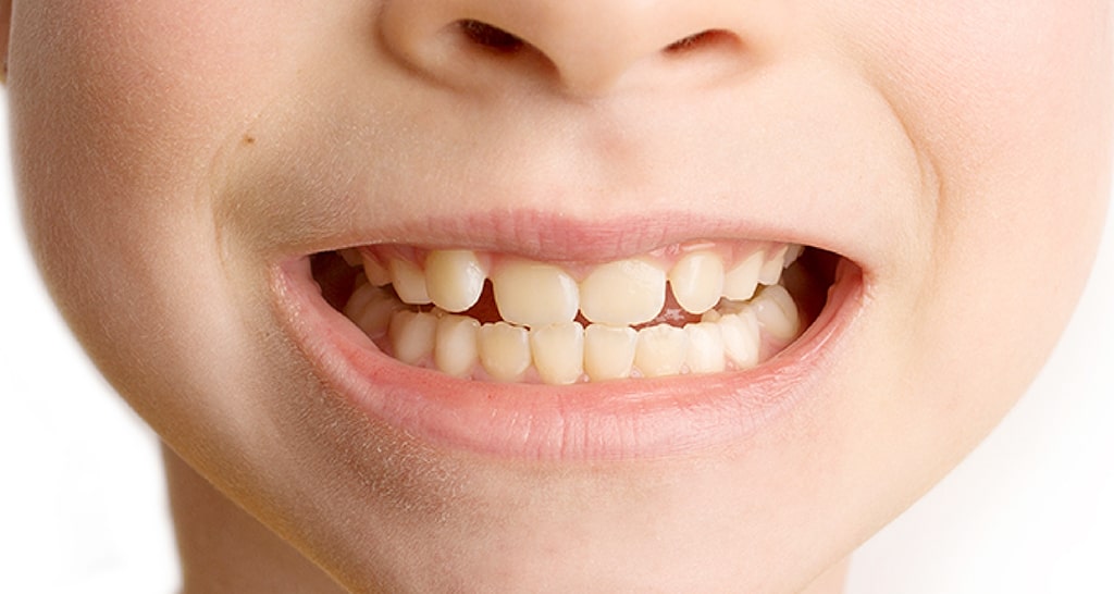 子どもの矯正（小児矯正）