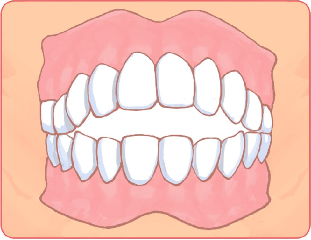 前歯がくっつかない（開咬）