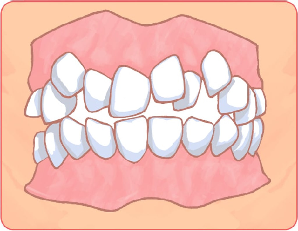 歯がでこぼこしている（叢生）