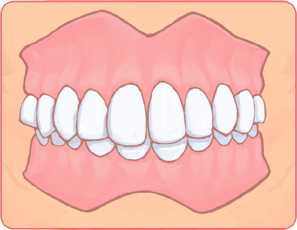 上の歯が被さっている（過蓋咬合）