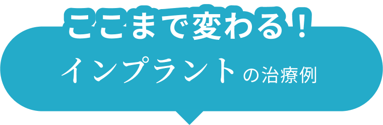 ここまで変わる！インプラントの治療例